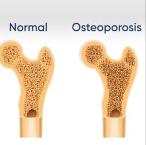 What is Osteoporosis?